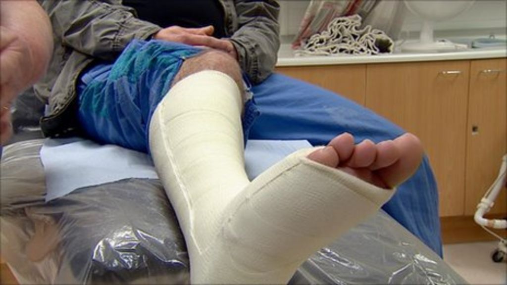 New Technique Could See End Of Plaster Casts Bbc News