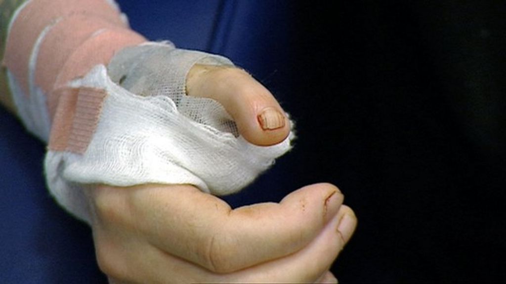 Thumbs up for man's toe swap operation BBC News