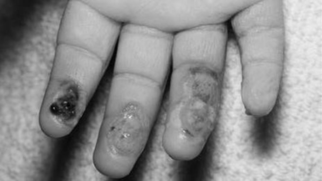 Home treadmill burns risk warning from Swansea and Birmingham surgeons