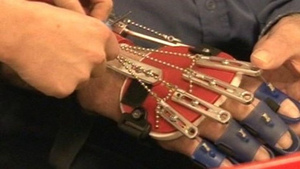 'Bionic arm' helps Colchester hospital stroke patients BBC News
