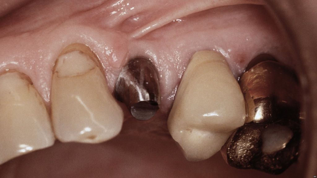 dental-implants-can-cause-nerve-damage-warns-study-bbc-news