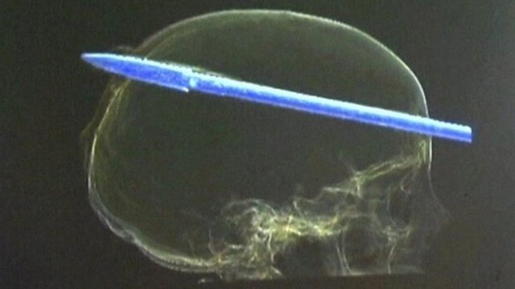 Florida teen recovering after spear gun accident BBC News