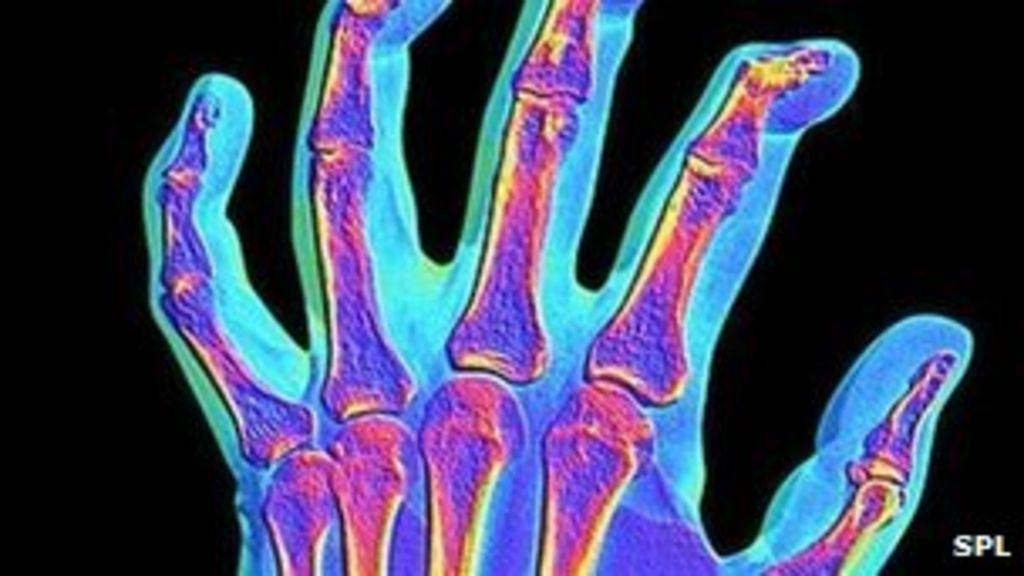 More links to osteoarthritis uncovered BBC News