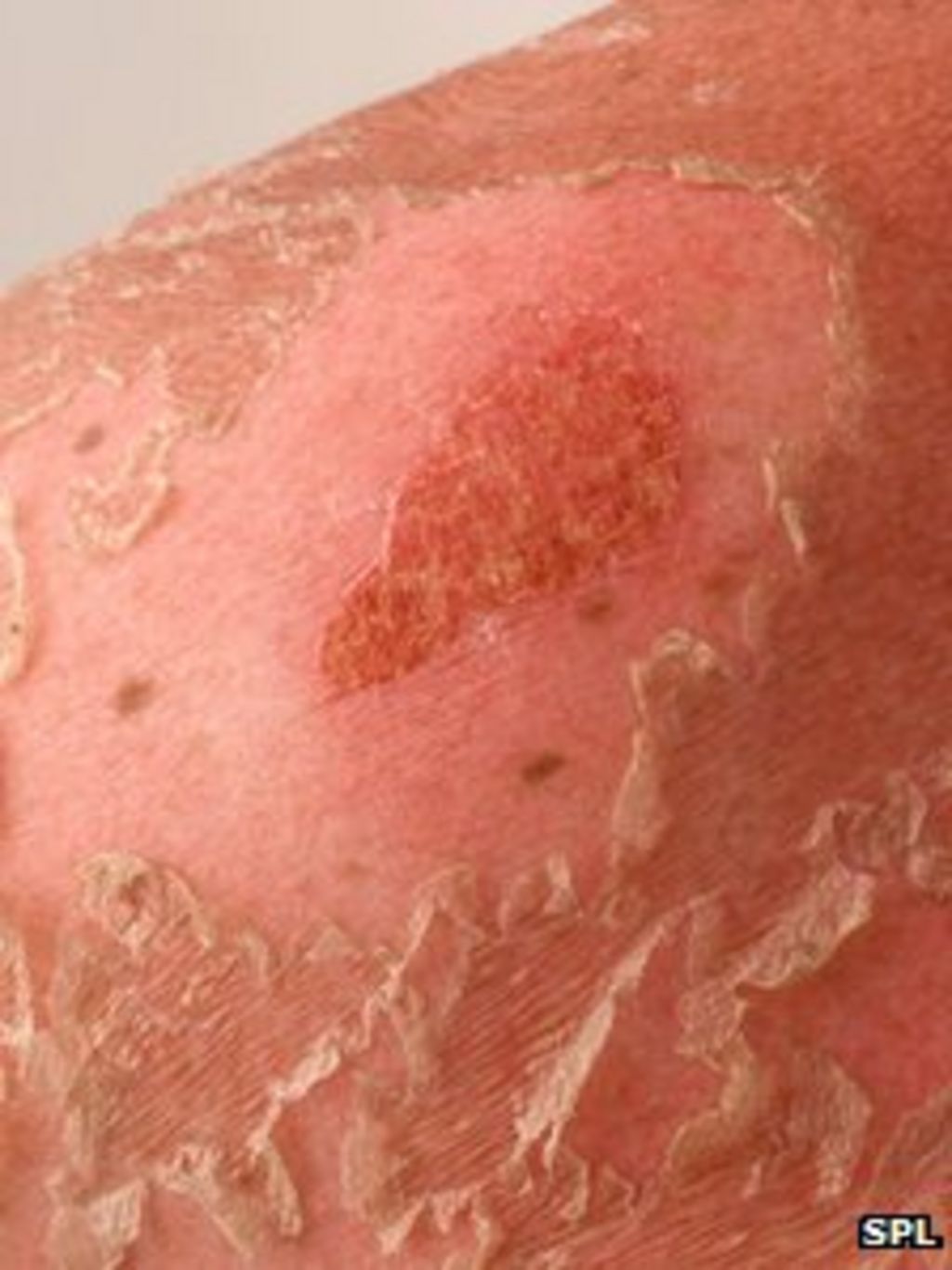 skin-cancer-rise-due-to-explosion-in-holidays-and-sunbeds-in-1970s