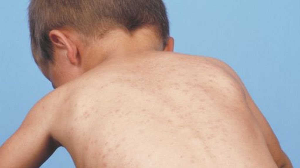 Measles Rise Mmr Jab Take Up Targets Not Hit In Wales Bbc News 