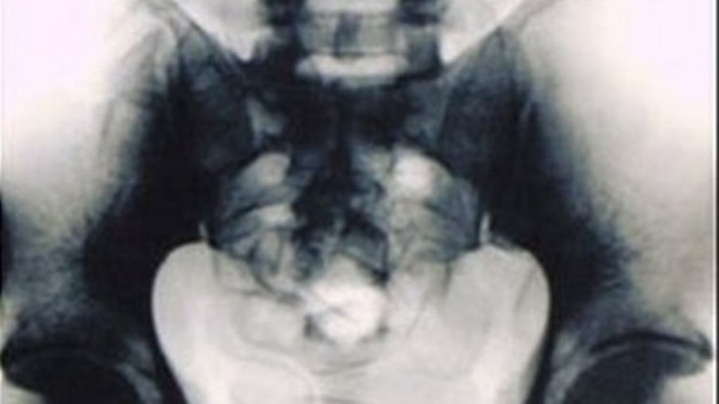 Smuggler had 30 drugs bags inside body BBC News