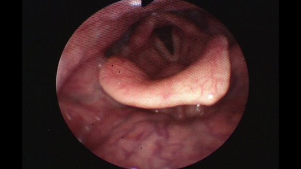 Endoscope Gives Close Up Look At Jeremy Vines Voice Box BBC News