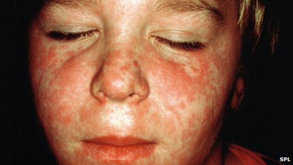 a-million-children-at-risk-of-measles-doctors-warn-bbc-news