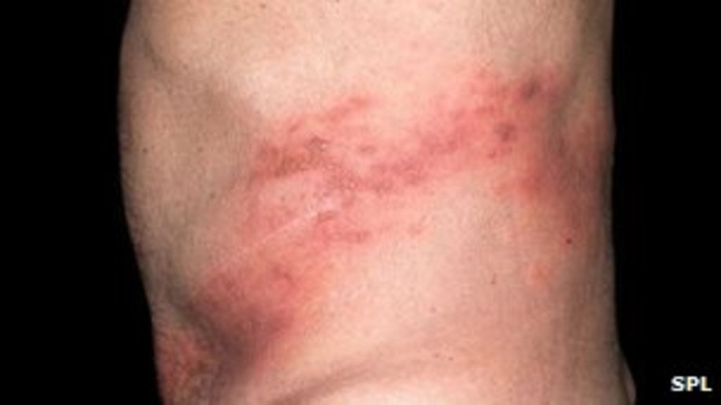 Q A Shingles BBC News    67303938 Shingles Rash On The Back Spl 1 