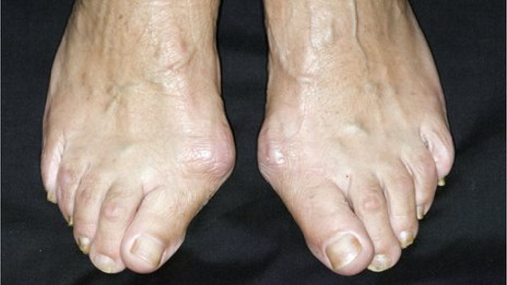 bunions-family-not-footwear-to-blame-bbc-news