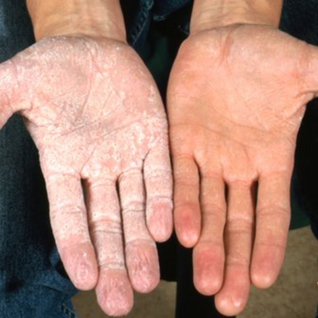 genetic-cause-of-spongy-hands-discovered-bbc-news