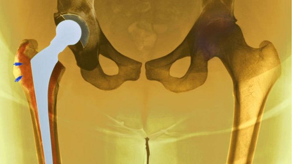 Hip replacement death rates show 'dramatic fall' - BBC News
