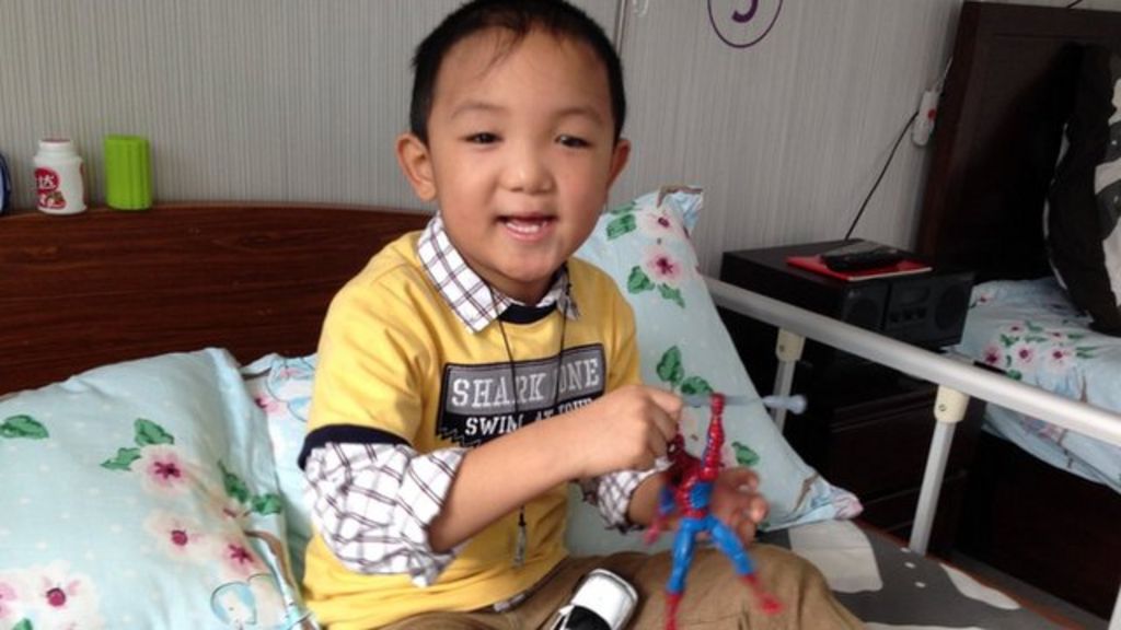 China eyegouge case Boy receives prosthetic implants BBC News