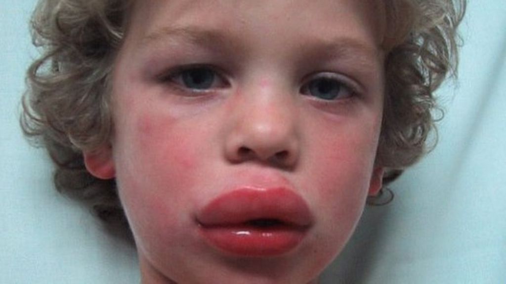 Q A Anaphylaxis Severe Allergic Reactions Explained BBC News