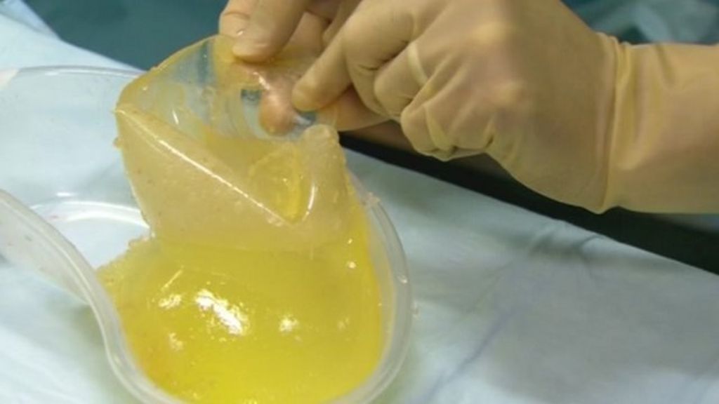 Pip Breast Implants £1 2m Removal Cost Not Being Reclaimed In Wales Bbc News