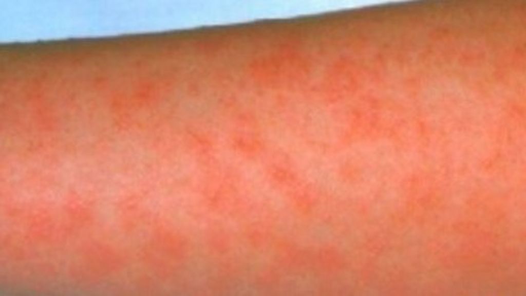 scarlet-fever-sharp-rise-in-cases-since-christmas-bbc-news