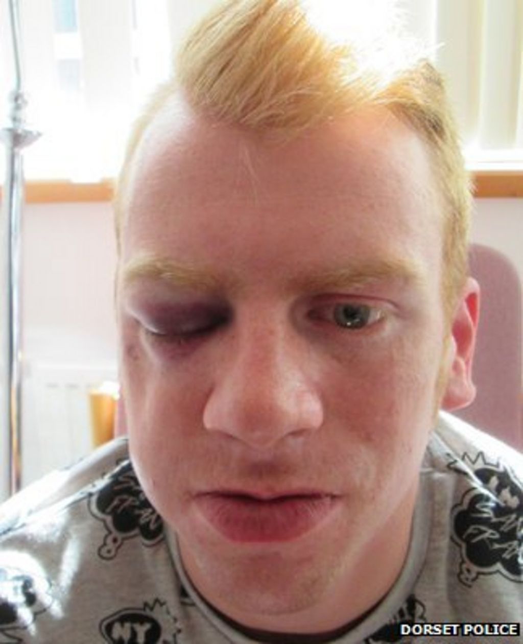 Poole Man Suffers Fractured Cheekbone In Stiletto Assault Bbc News 9753