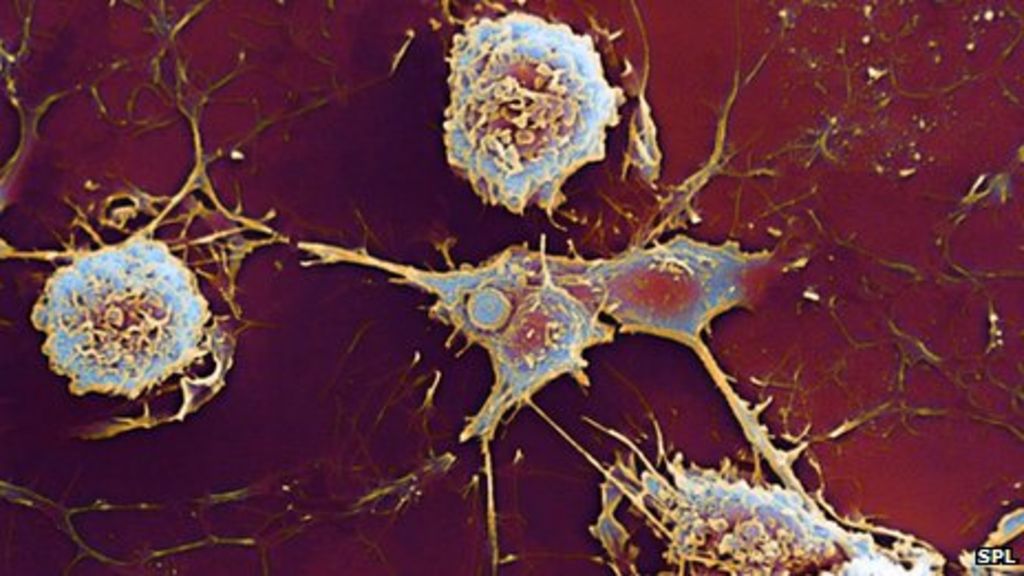 Multiple Sclerosis Discovery May Explain Gender Gap Bbc News