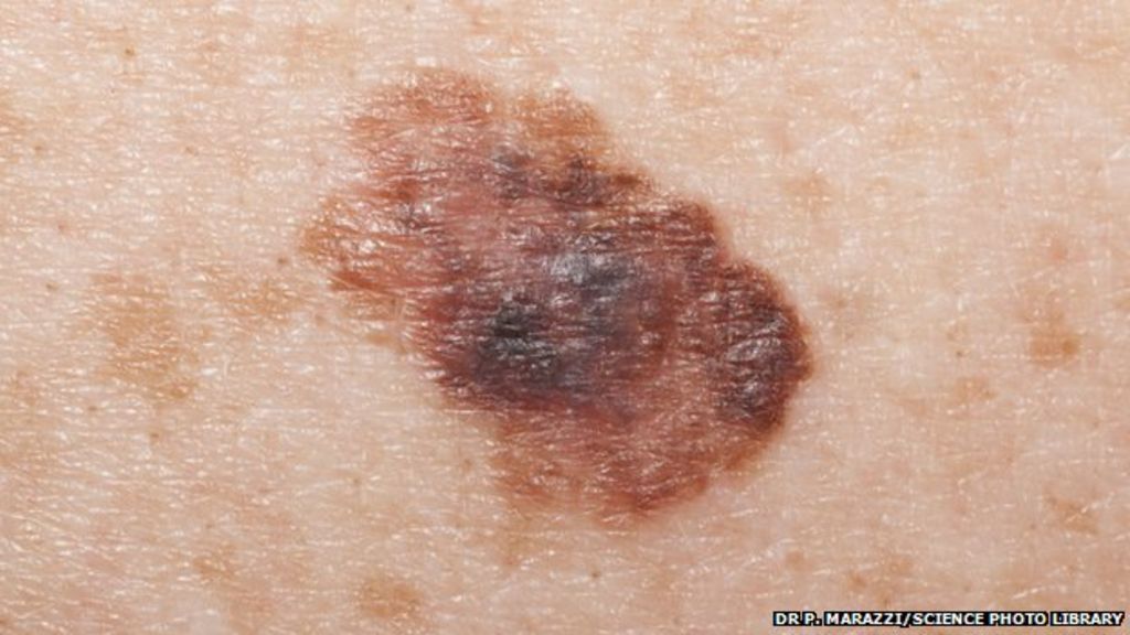 Green light for new skin cancer drug - BBC News