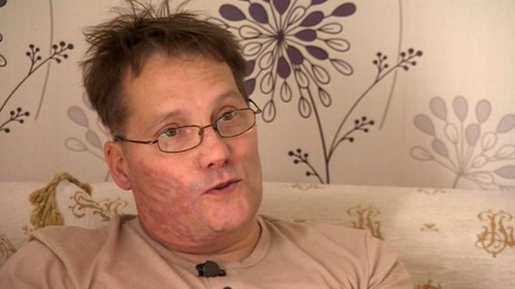 Witham acid attack victim tells of 'face melting' BBC News
