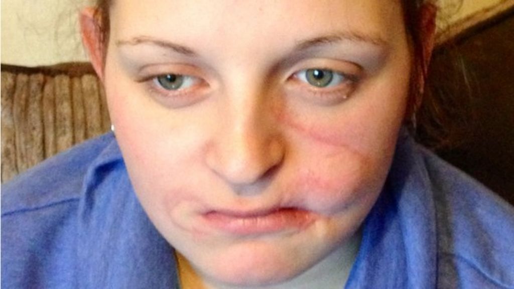 Dog attack woman files compensation case against friend BBC News