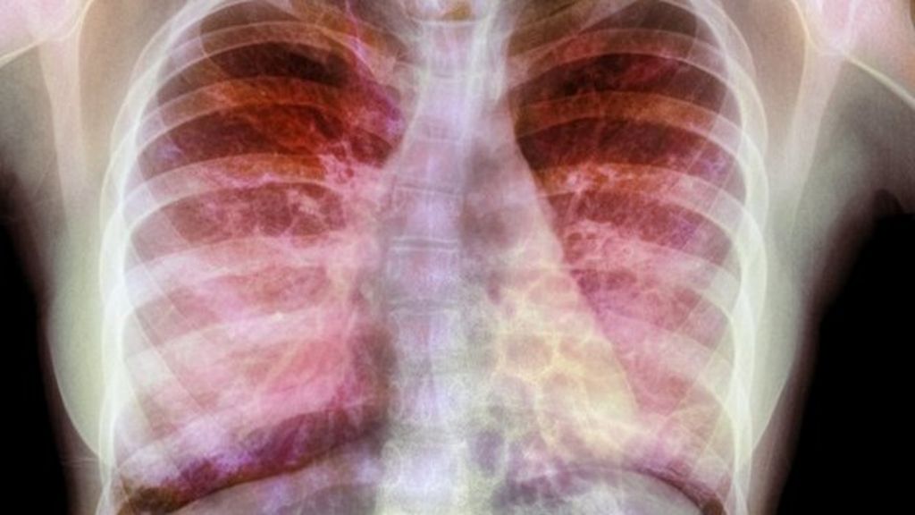 Gene therapy stabilises lungs of cystic fibrosis patients - BBC News