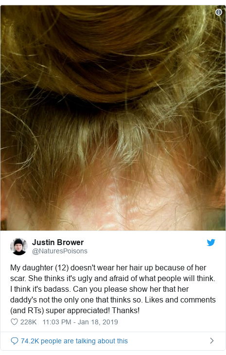 Twitter post by @NaturesPoisons: My daughter (12) doesn't wear her hair up because of her scar. She thinks it's ugly and afraid of what people will think. I think it's badass. Can you please show her that her daddy's not the only one that thinks so. Likes and comments (and RTs) super appreciated! Thanks! 