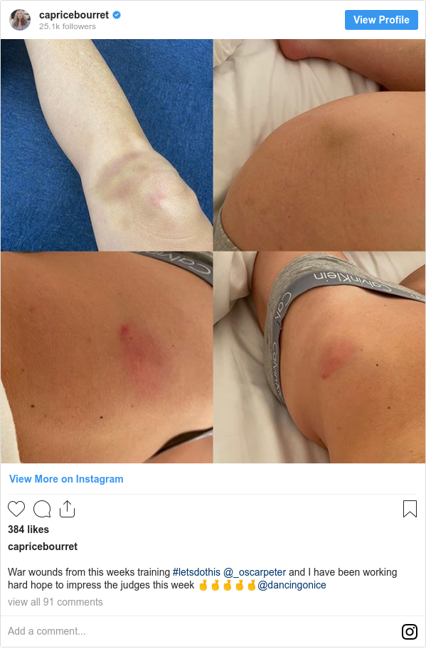 Instagram post by capricebourret: War wounds from this weeks training  #letsdothis @_oscarpeter and I have been working hard hope to impress the judges this week 🤞🤞🤞🤞🤞@dancingonice