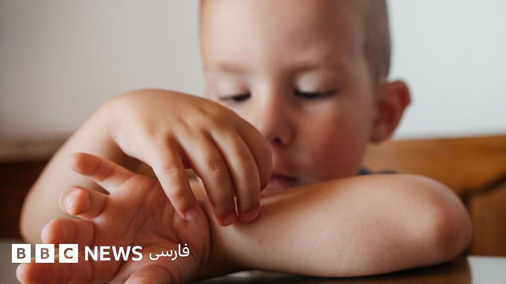 کودکی در حال خاراندن محل گزش پشه