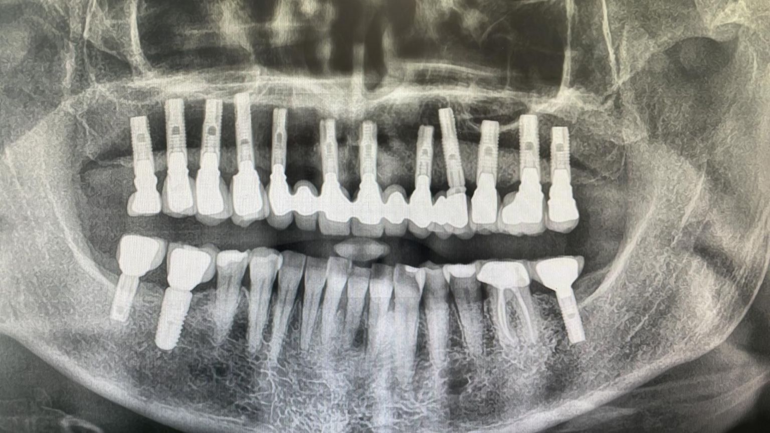 X-ray of Sarah's implants