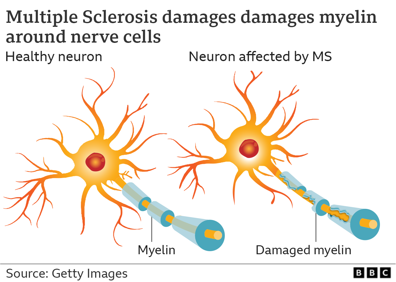 image showing damage to myelin sheath