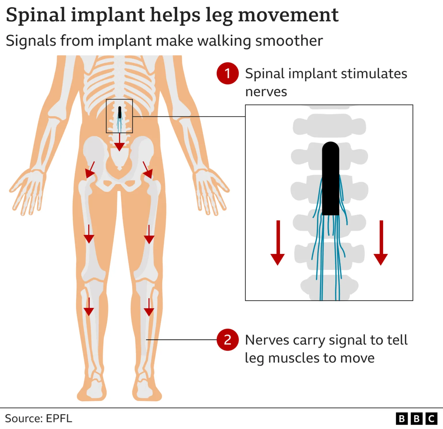 BBC News Spinal implant graphic. 