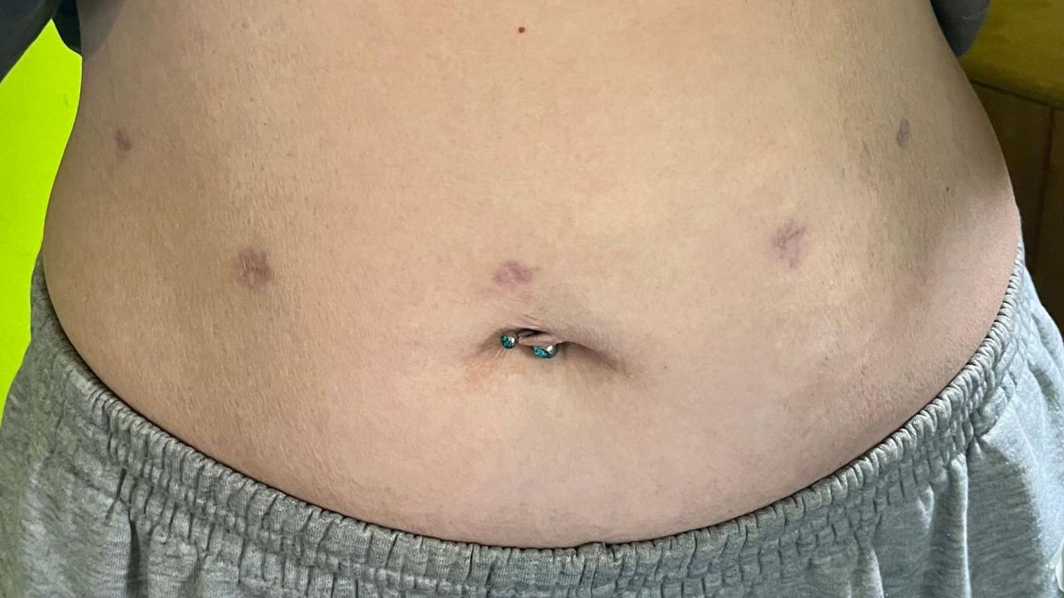 Stomach of patient showing five keyhole scars