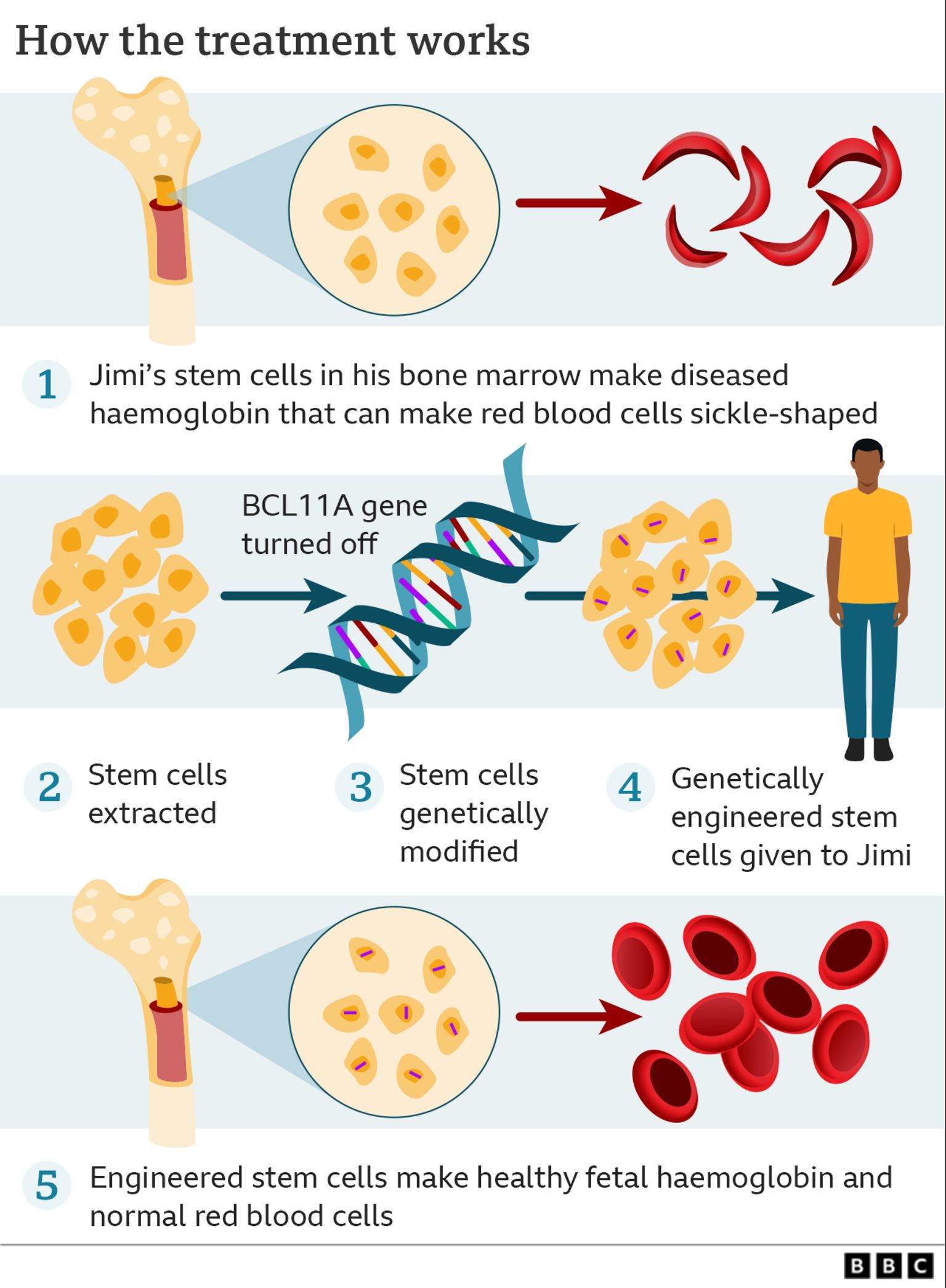 gene-editing-for-sickle-cell-disease-succeeded-bioinformatics-hub