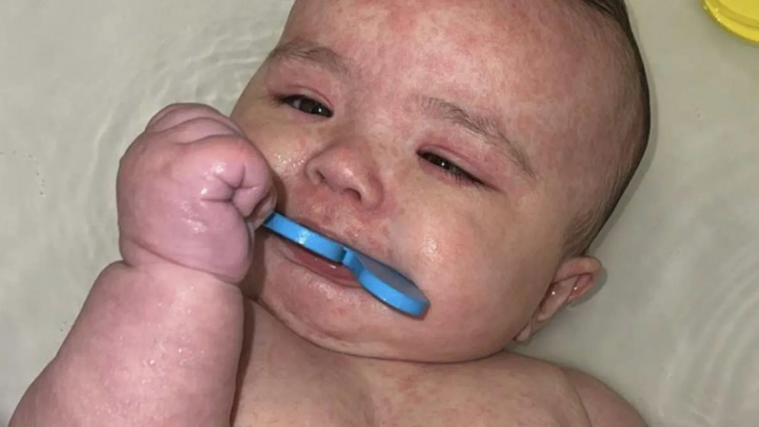 How Canada became the centre of a measles outbreak in North America