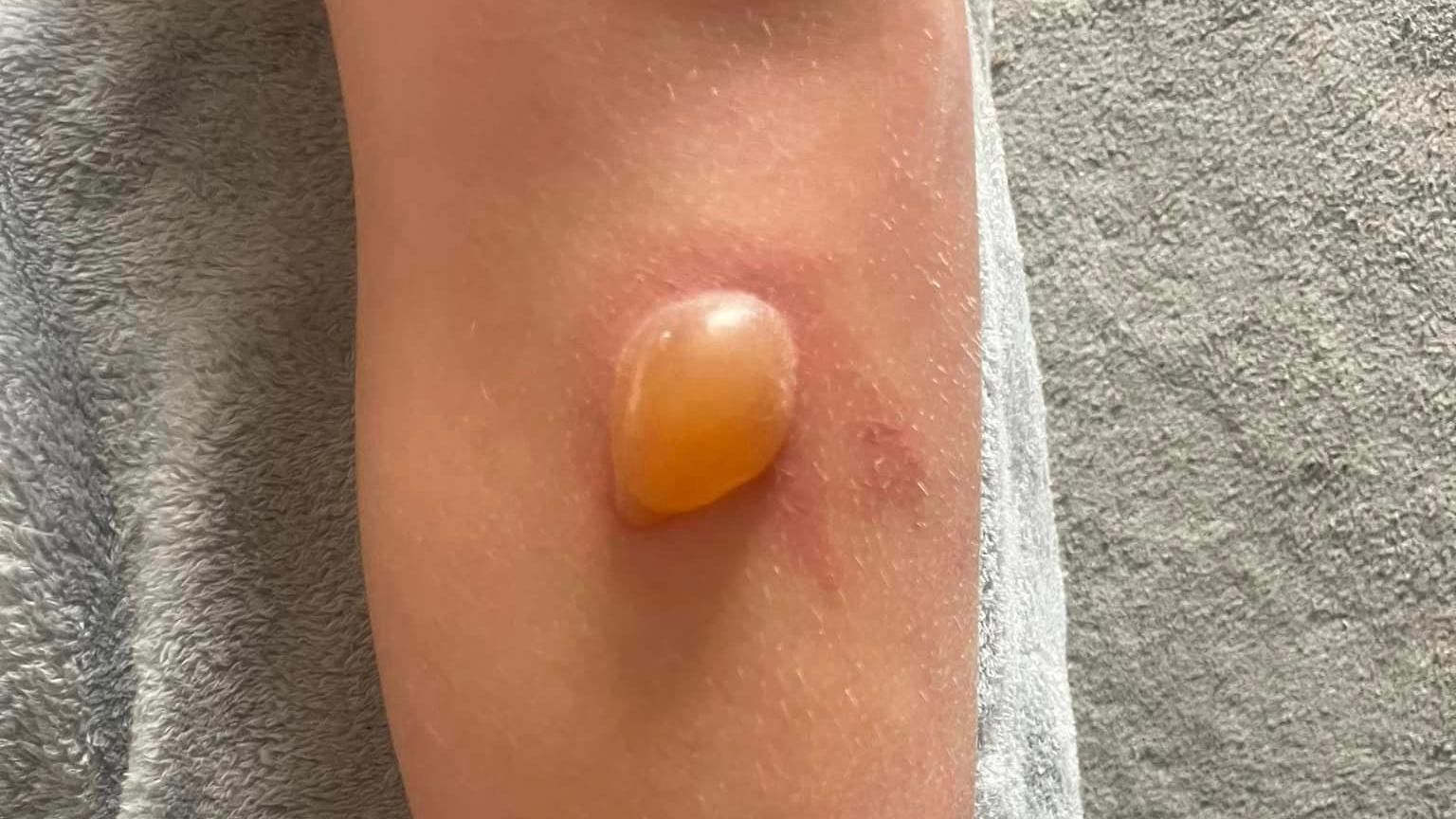 A yellow pus-filled blister on a boy's leg, as a result of giant hogweed