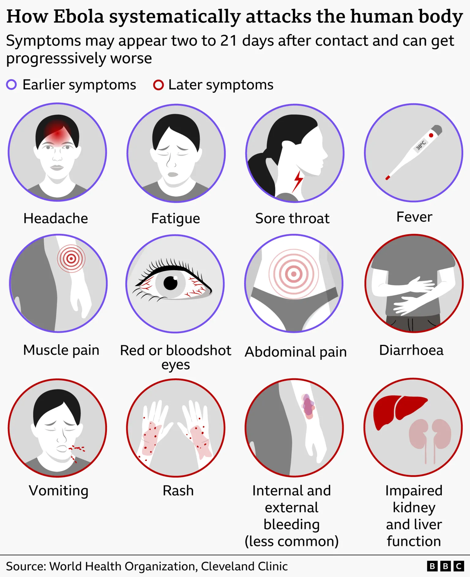 Graphic showing how Ebola attacks the human body, sourced to the WHO and Cleveland Clinic. Graphic showing how Ebola systematically attacks the human body. It explains that symptoms appear two to 21 days after contact and can worsen over time. Earlier symptoms, shown with purple circles around diagrams, include headache, fatigue, sore throat, fever, muscle pain, red or bloodshot eyes, and abdominal pain. Later symptoms, shown with red circles, include diarrhoea, vomiting, rash, internal and external bleeding (less common), and impaired kidney and liver function.