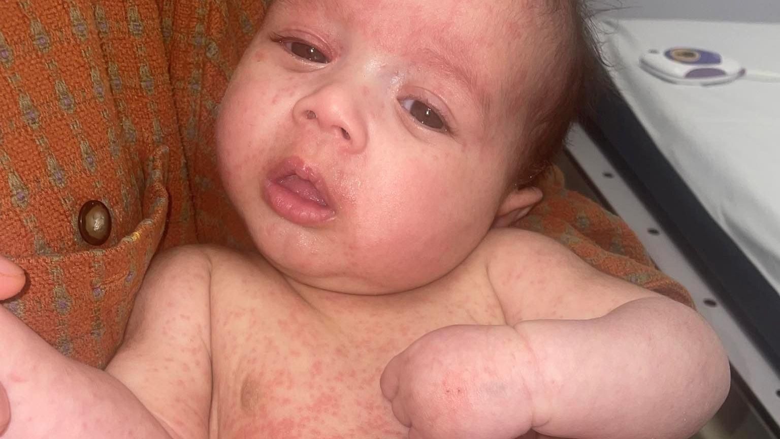 Ezra was a baby when he developed measles