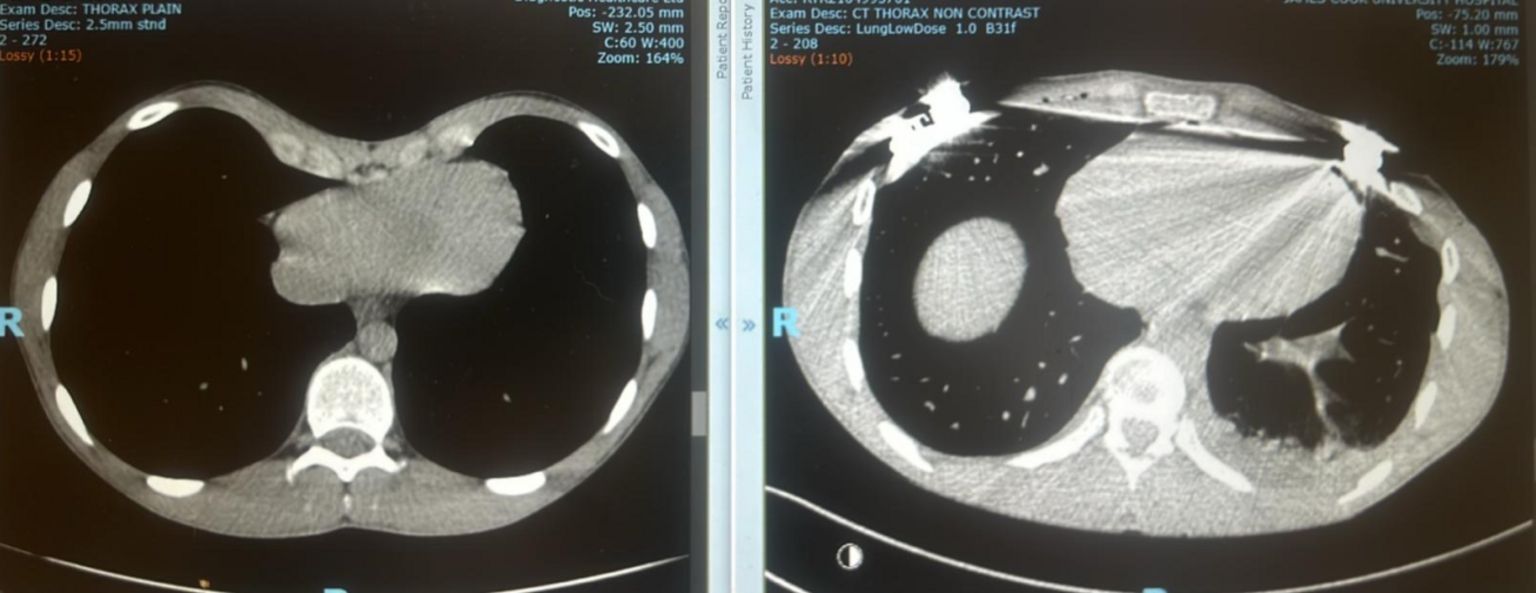 Louis's chest scans before and after the operation