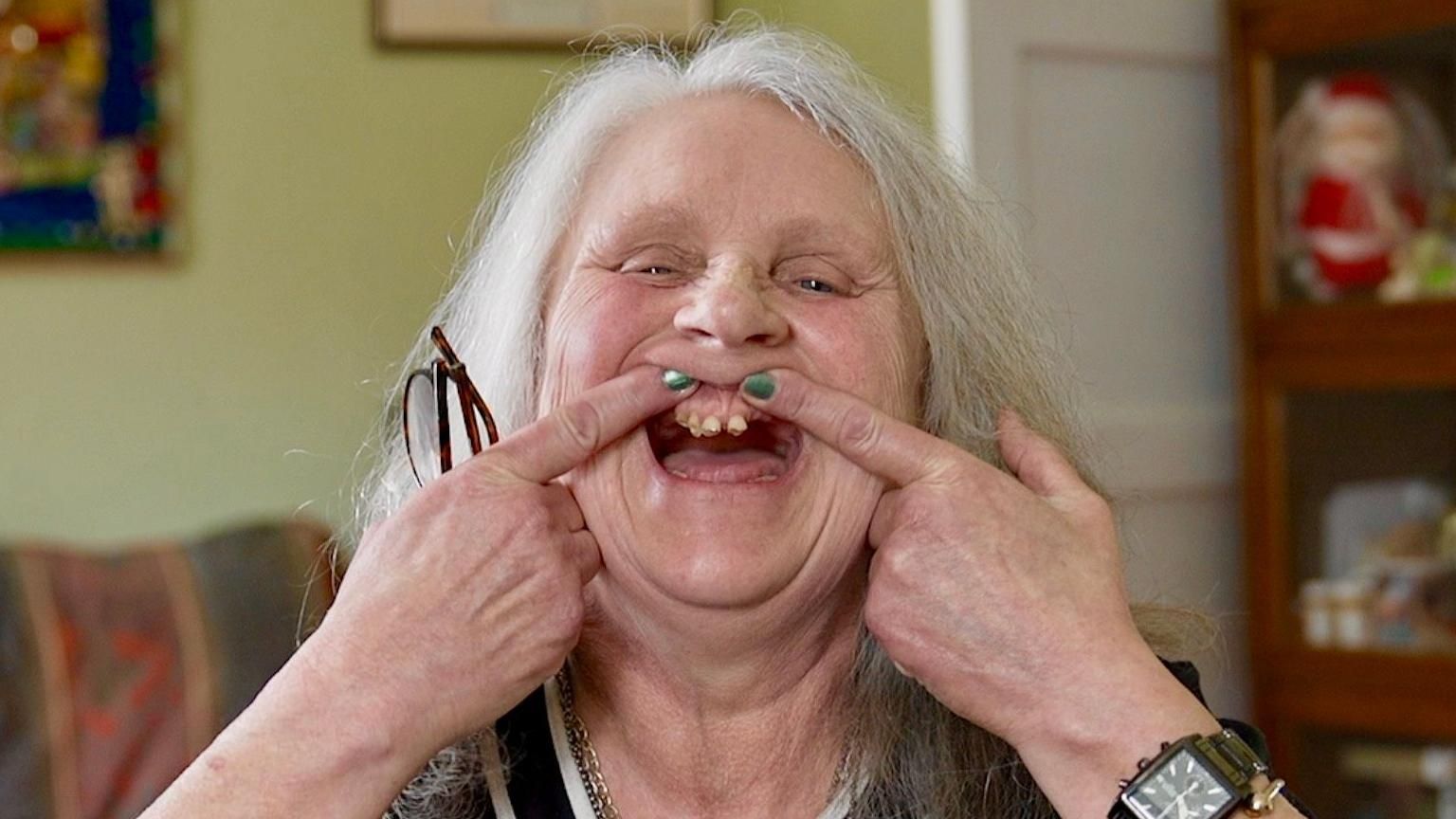 Pamela Widdison showing her teeth, which she says look like 'stumps'
