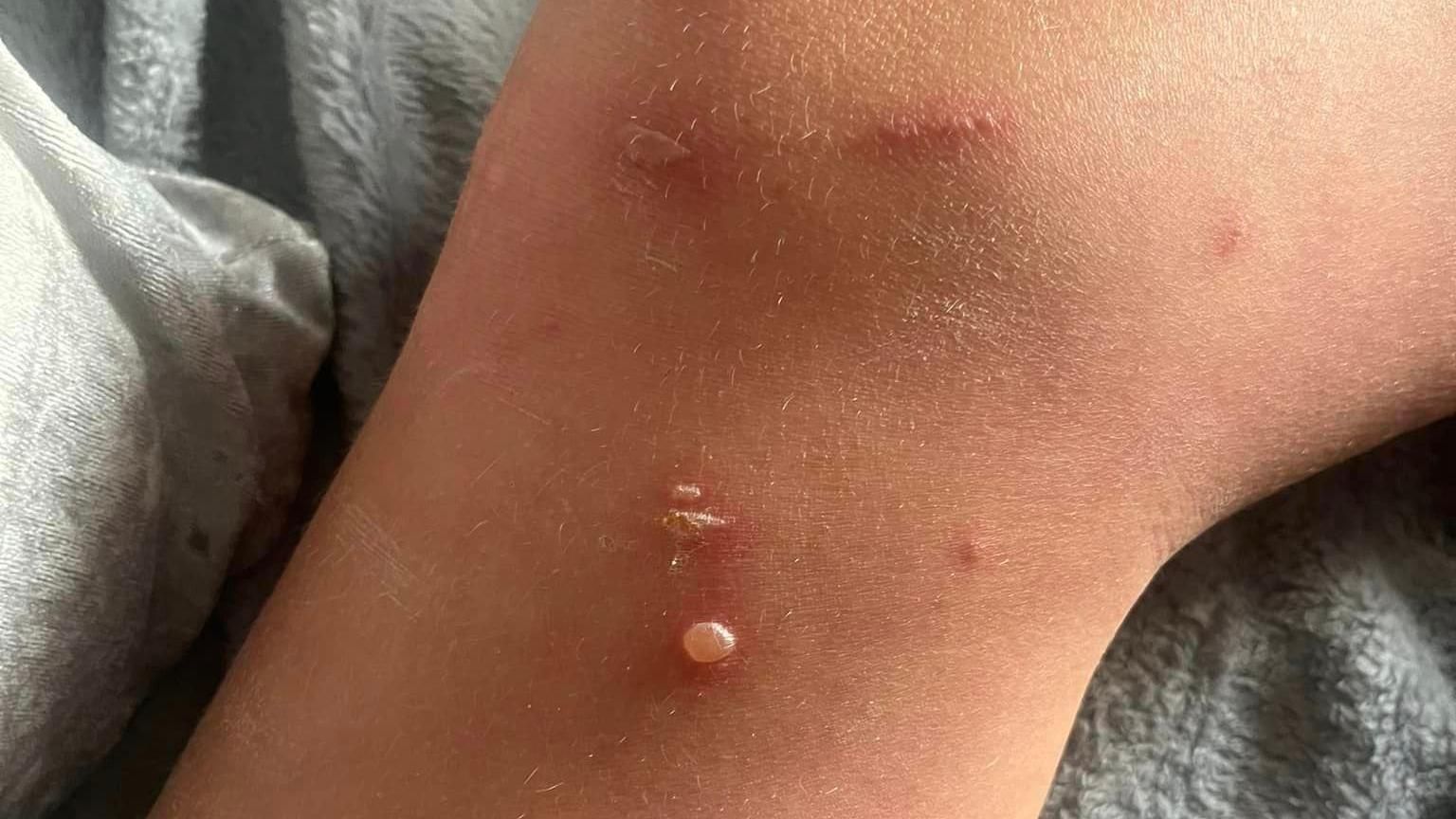 Giant hogwood stings on a boy's leg, which are small and filled with pus.