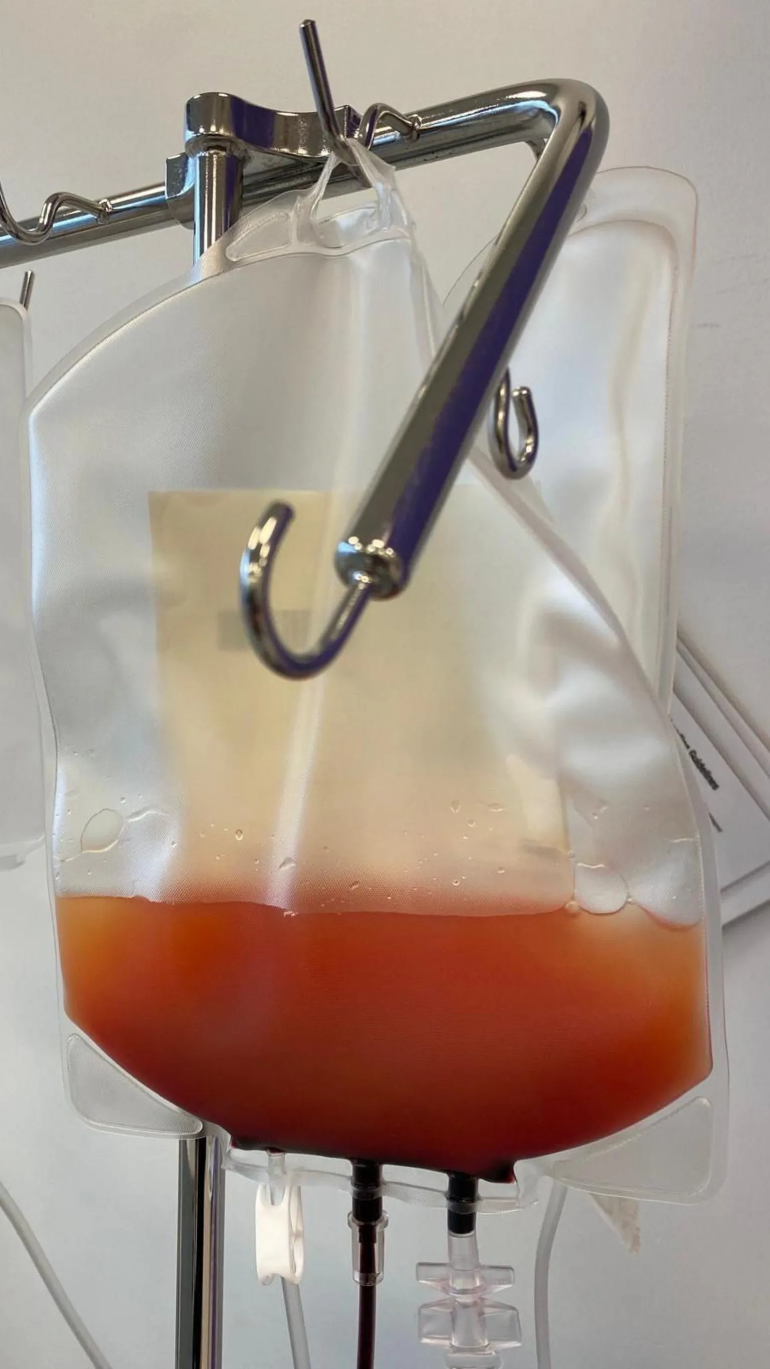 Katie Tinkler The image shows a close-up of a medical fluid bag hanging from a metal stand with several curved hooks. The transparent bag contains a deep reddish liquid pooled in the lower half, with condensation droplets visible on the inside surface. At the bottom of the bag, there are two outlet tubes connected, with the liquid visible inside one of them. The stand is made of shiny metal with multiple arms designed to hold equipment securely in place. The background is plain and clinical, suggesting a healthcare environment such as a hospital or treatment room.