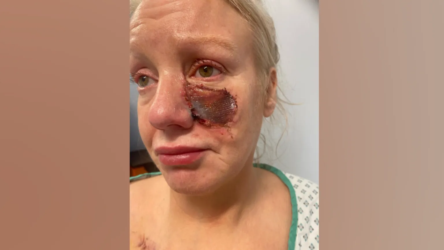 Reportan brutal ataque de perro salchicha: le arrancó una mejilla a una mujer y se la comió