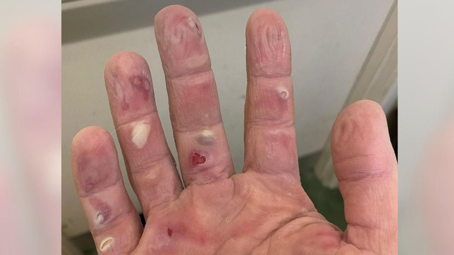 The palm of a man's right hand covered in blisters