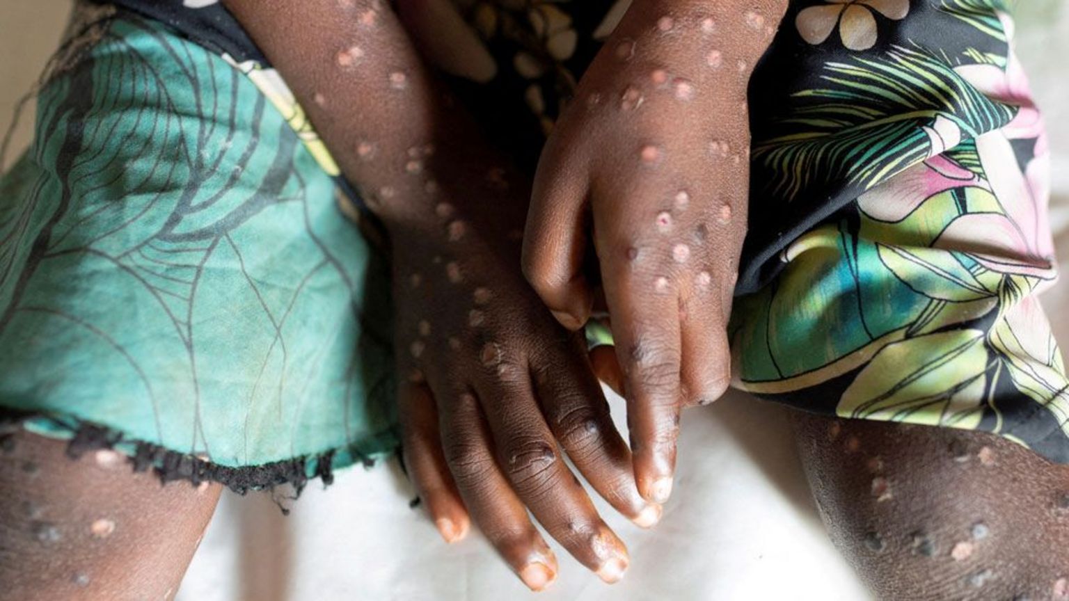 Le Mpox déclaré urgence de santé publique en Afrique