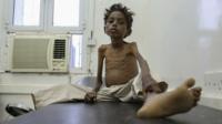 A 5 year old boy on a hospital bed in Yemen