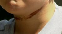 Michael Ryan-Mansfield's neck injuries