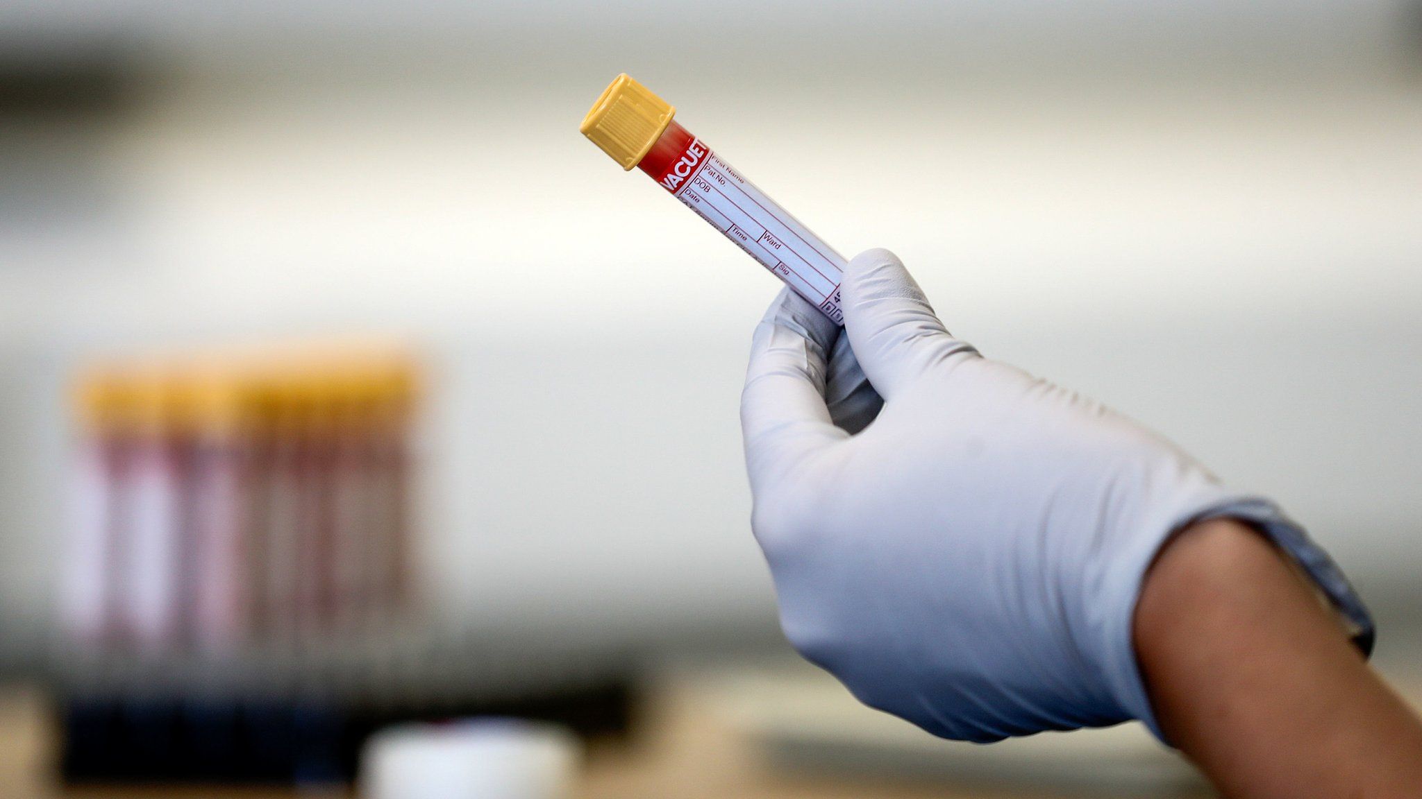 Blood sample being held in a gloved hand