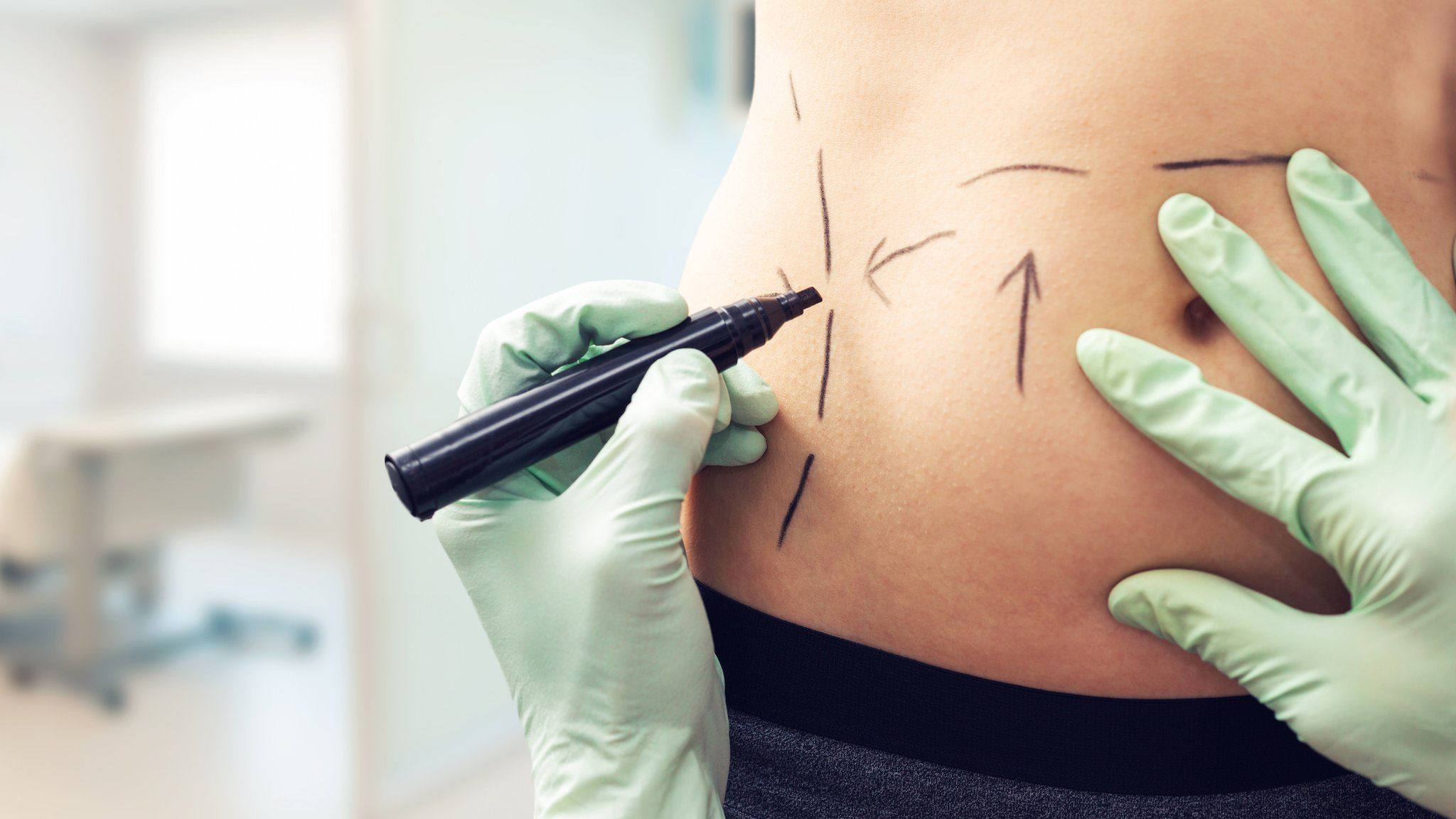 A patient is marked up for liposuction