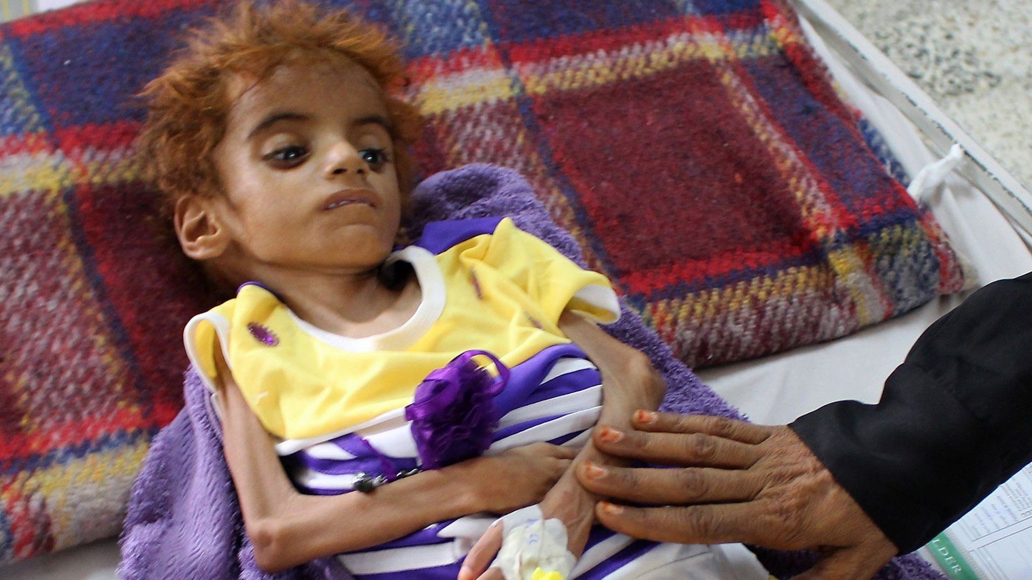 A Yemeni child suffering from malnutrition receives treatment at a hospital in Hajjah province (8 September 2018)